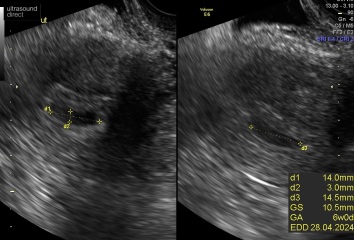 5 and half week scan no yolk or pole- help