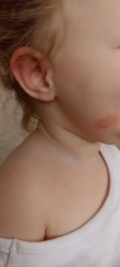 Red patches dry skin
