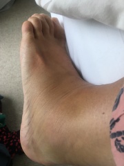 Does this look like a bad sprain to you?