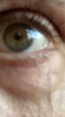 Botox (with photos)