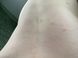 skin rash