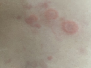 Can anyone help - is this pityriasis rosea??
