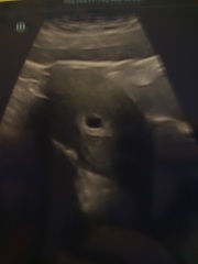 No fetal pole at 6 weeks - any stories?