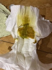 (Pics alert!) Combi fed baby very runny poo / diarrhea