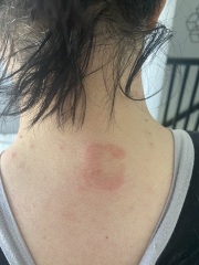 Can anyone help - is this pityriasis rosea??