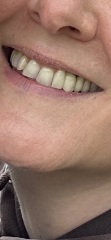 Permanent crown looks worse that temporary