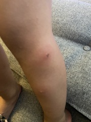 Strange abscess on kids legs (with pics)?