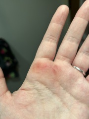 Weird bruise on hand ?!