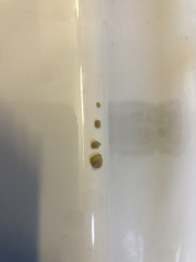 Tonsil Stones… Help! (Warning, gross images)