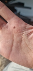 Could this be Melanoma?