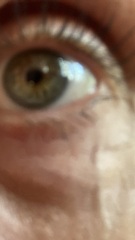 Botox (with photos)