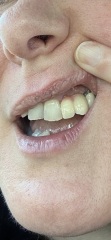 Permanent crown looks worse that temporary