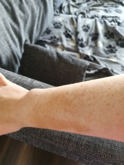 Skin stain after iron infusion