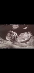Nub theory. Girl or boy?