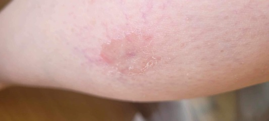 Is this Bulls Eye ( Lyme disease)? Pictures added, any Dr here please?