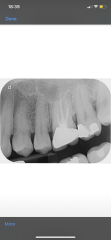 Toothache
