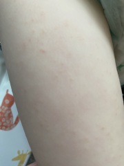 Rash, any ideas?