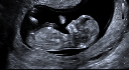 PLEASE HELP WITH BABY GENDER GUESSES NUB THEORY