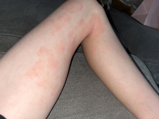 Eczema