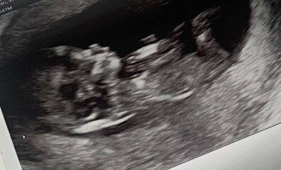 Has anyone had nub theory be wrong?