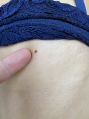 Angry I can't get an appointment with Gp. Pic of mole