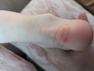 Eczema or something else?