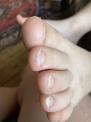 Curved nails  - warning photos of feet