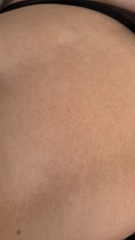 Petechiae rash?