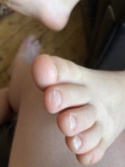 Curved nails  - warning photos of feet