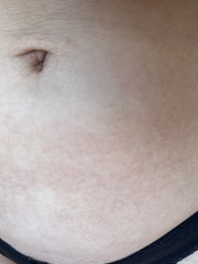 Weird patches on skin? Rash? Petechiae?