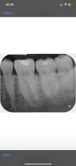 Toothache