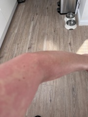 Rash on arms and legs