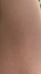 Petechiae rash?
