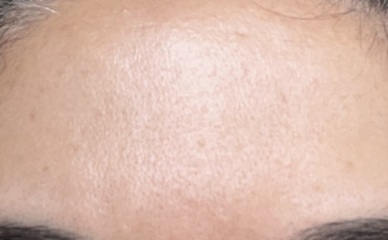 37 forehead worries