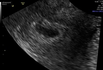 5 and half week scan no yolk or pole- help