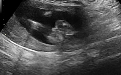 16 Week Scan - Sonographer not confident… what’s your guess? Potty shots!