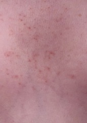 Is this Chicken Pox?