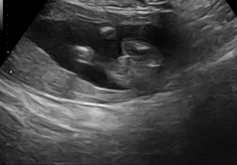 16 Week Scan - Sonographer not confident… what’s your guess? Potty shots!