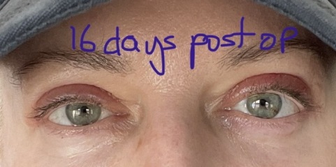 Upper Blepheroplasty