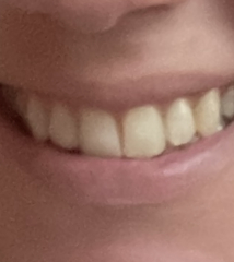 Yellow teeth