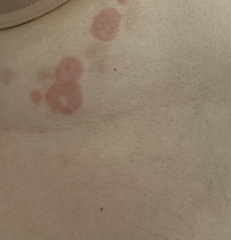 Can anyone help - is this pityriasis rosea??