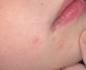 What is this? Cold sore/HFM/impetigo?