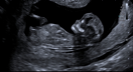 PLEASE HELP WITH BABY GENDER GUESSES NUB THEORY