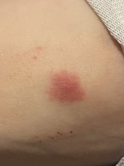 Another rash/bite picture