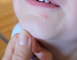 Impetigo or scratch? (Pics)