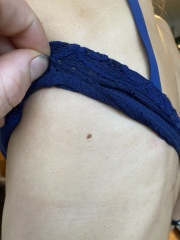 Angry I can't get an appointment with Gp. Pic of mole