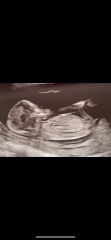 Nub theory. Girl or boy?