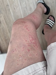 Rash on arms and legs