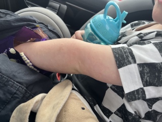 Toddler white rash