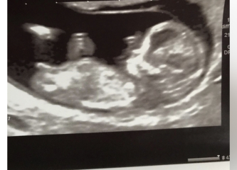 Siblings Scan Identical - same gender?!